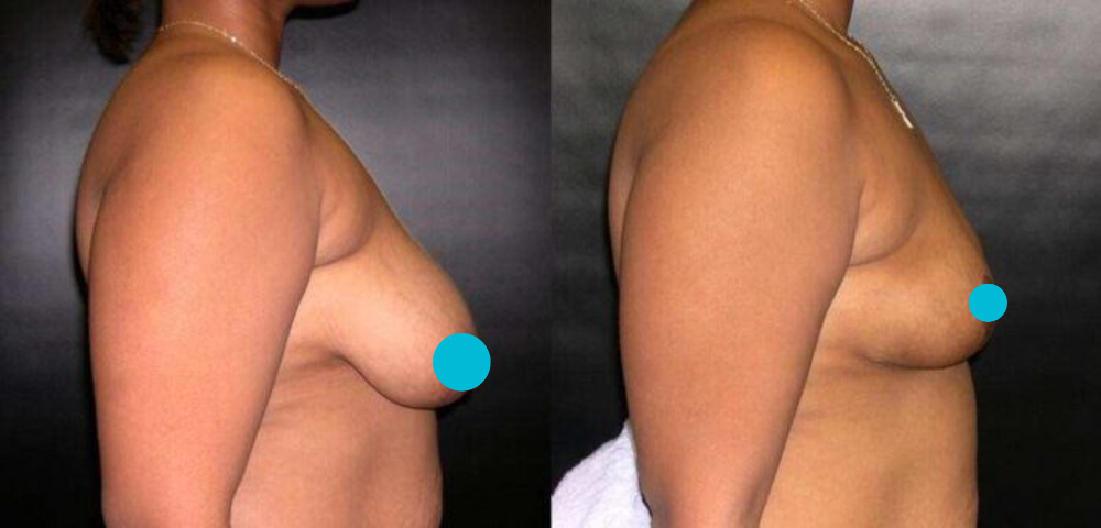 Breast Reduction before and after - profile view