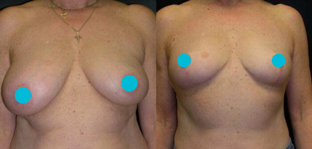 Breast Reduction before and after - frontal view