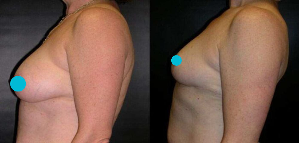 Breast Reduction before and after - profile view