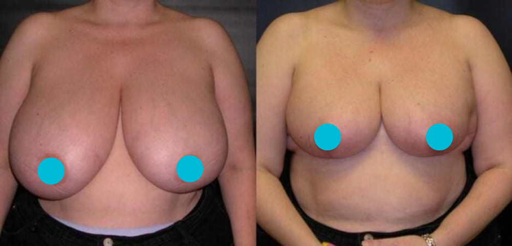 Breast Reduction before and after - frontal view