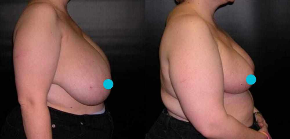Breast Reduction before and after - profile view