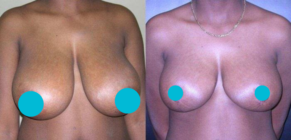 Breast Reduction before and after - frontal view