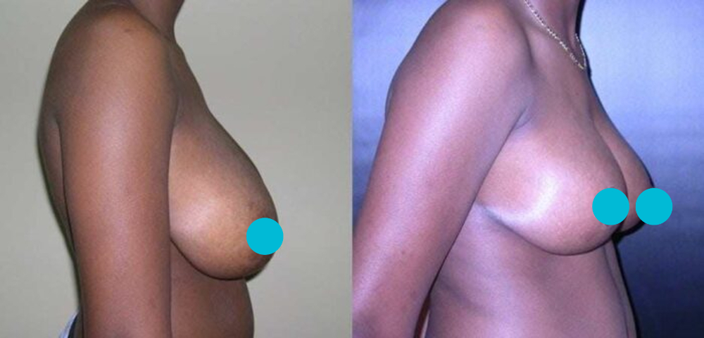 Breast Reduction before and after - profile view