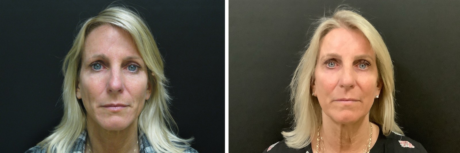 Botox before and after - frontal view