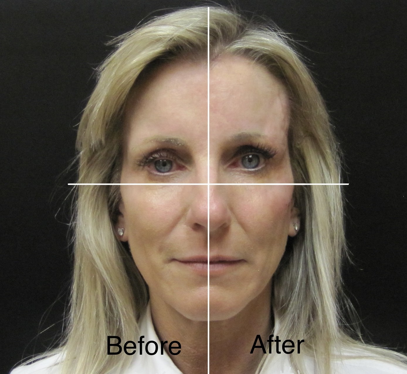 Botox before and after - frontal view