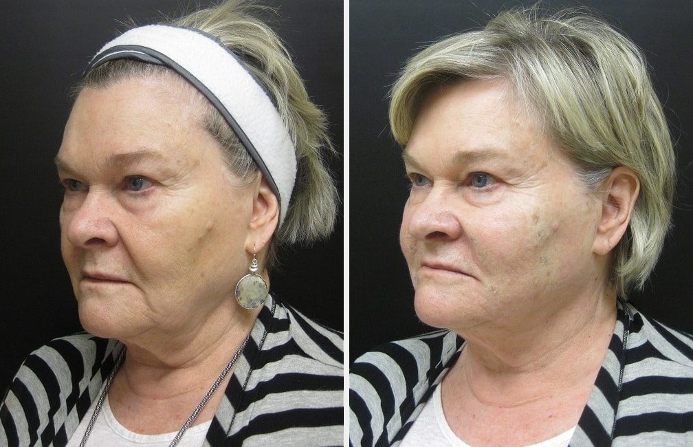 InstaLift before and after - oblique view