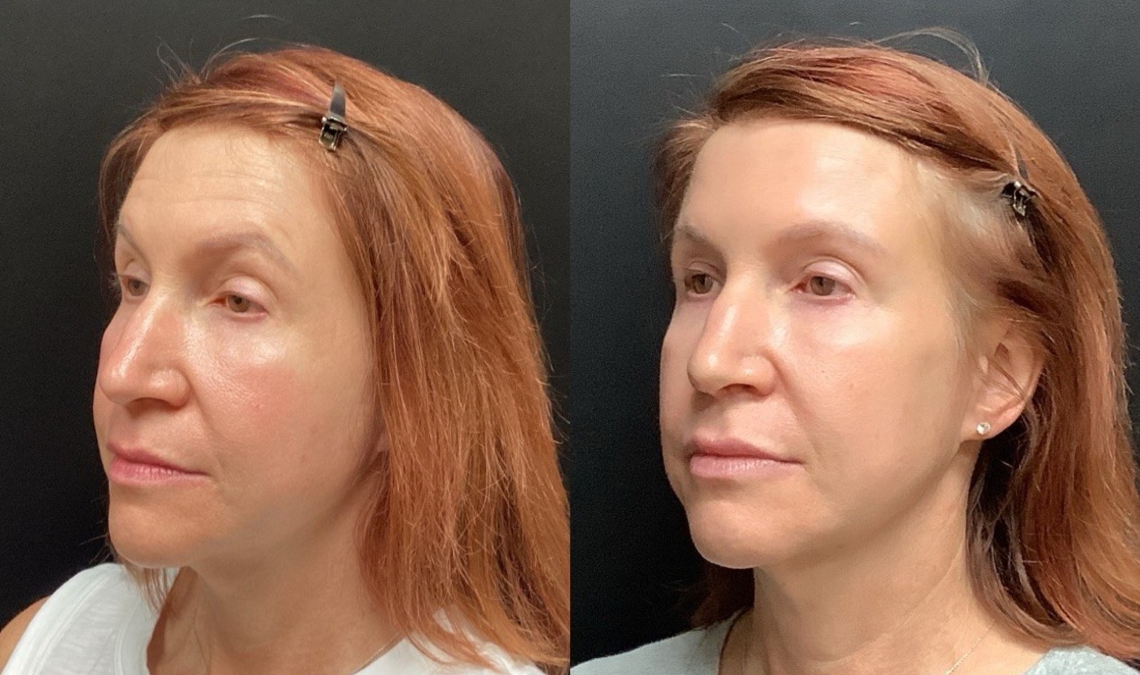 Juvéderm Family of Fillers before and after - oblique view