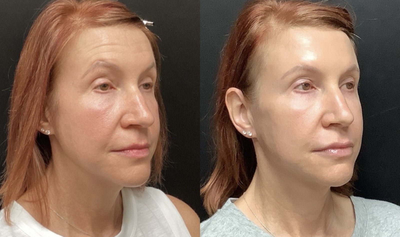 Juvéderm Family of Fillers before and after - oblique view