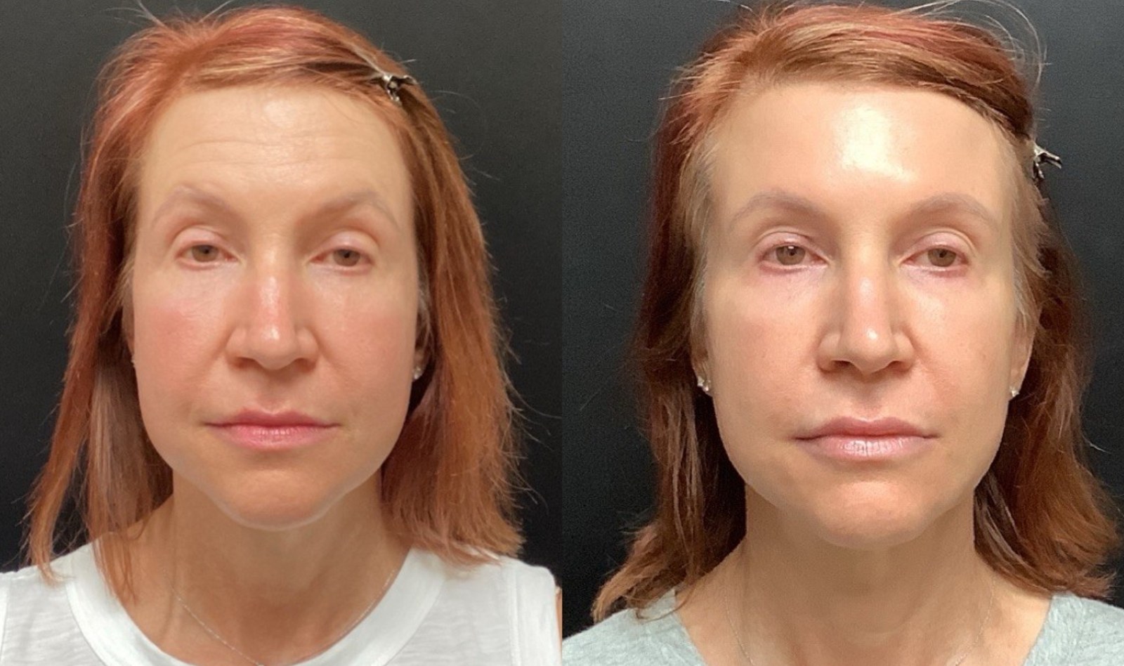 Juvéderm Family of Fillers before and after - frontal view