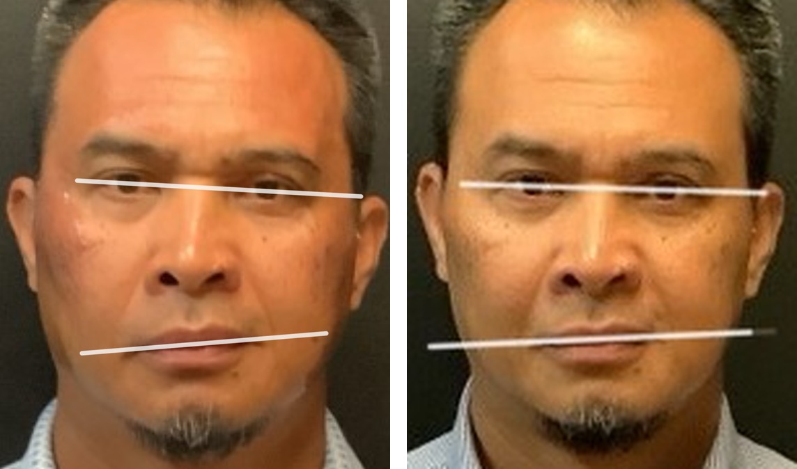 Juvéderm Family of Fillers before and after - frontal view