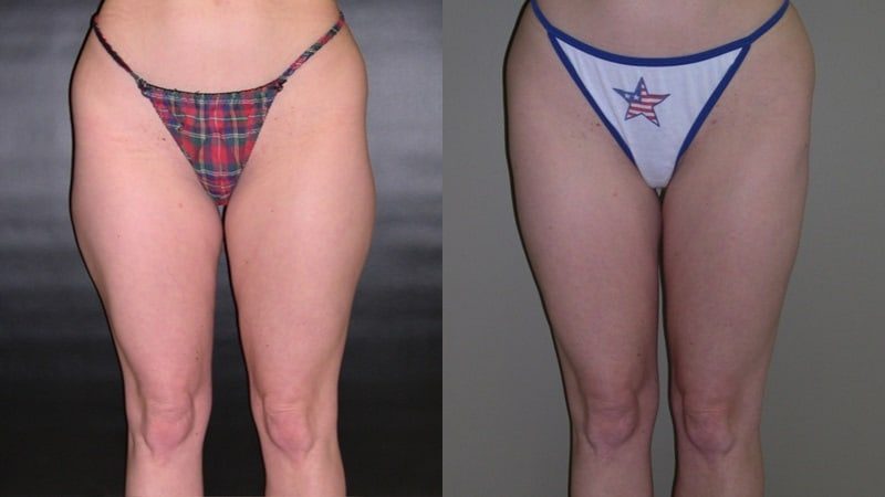 Liposuction before and after — Front view