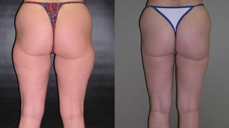 Liposuction before and after — Back view