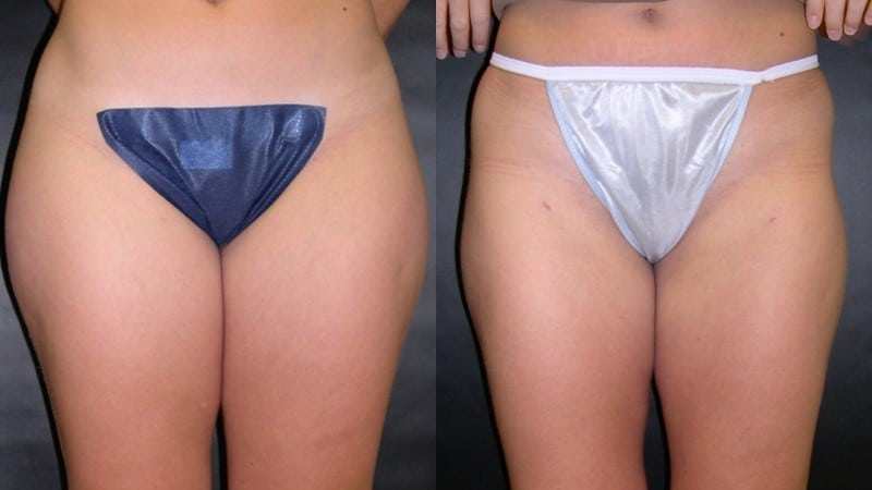 Liposuction before and after — Front view