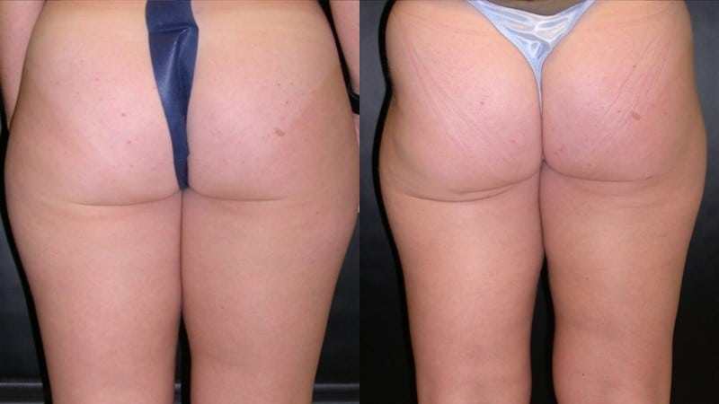 Liposuction before and after — Back view