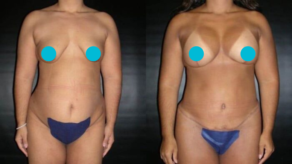 Mommy Makeover before and after - frontal view