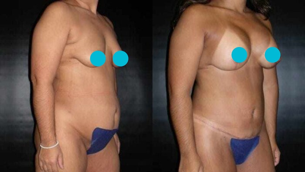 Mommy Makeover before and after - oblique view