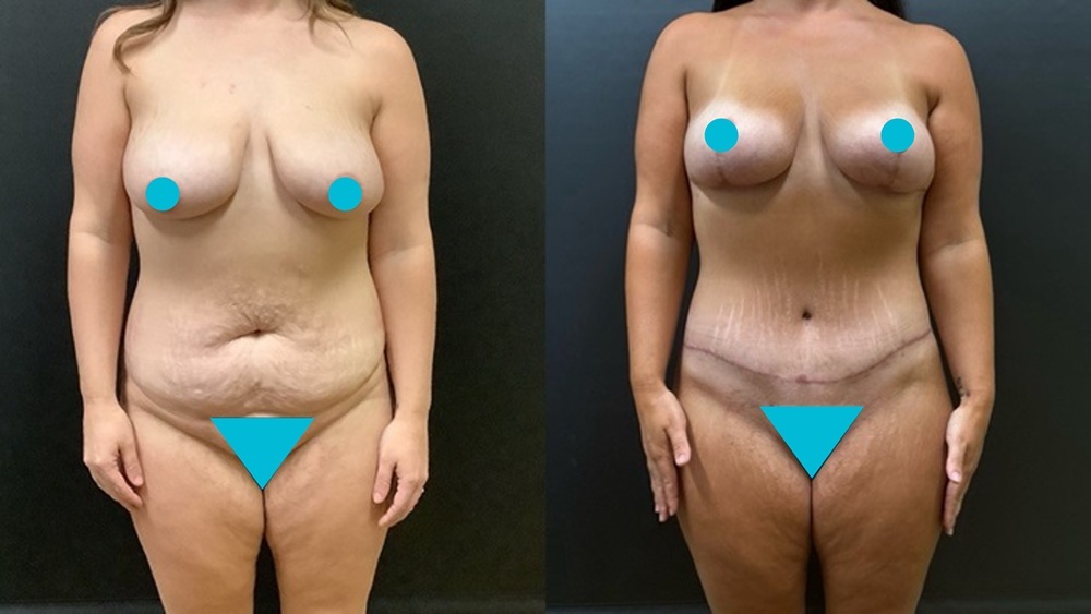 Mommy Makeover before and after - frontal view