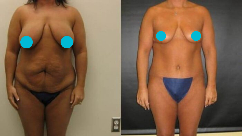 Mommy Makeover before and after - frontal view