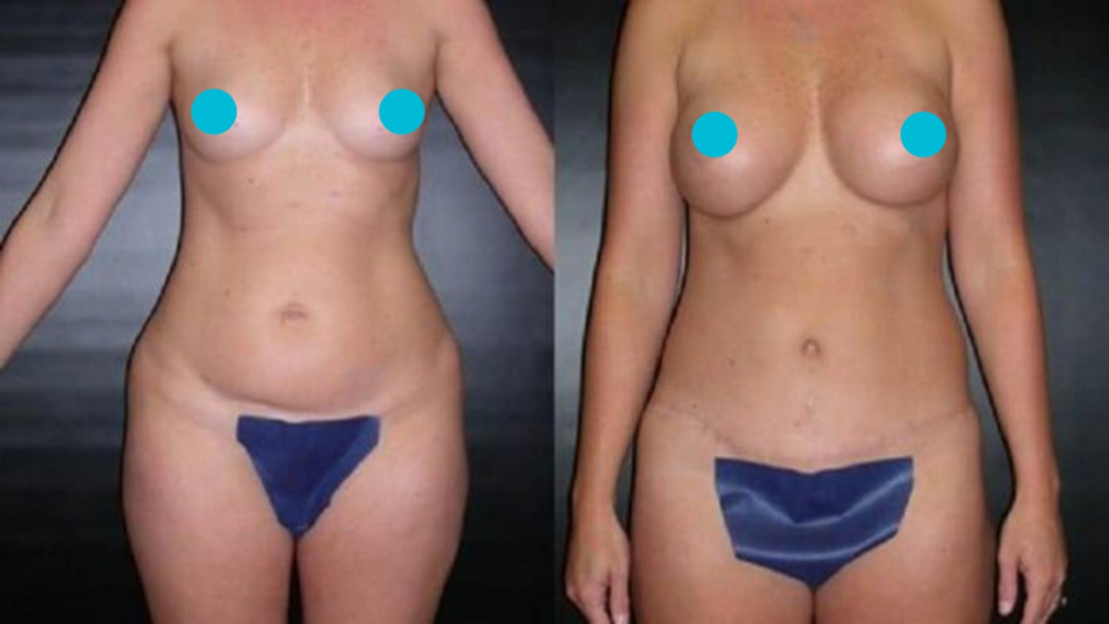 Mommy Makeover before and after - frontal view