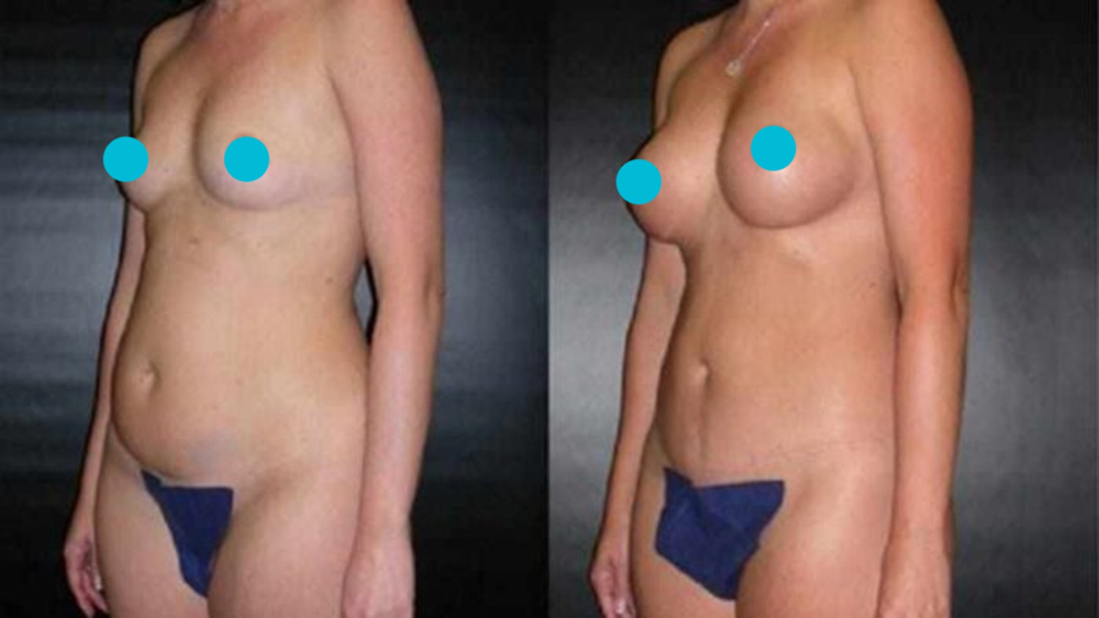 Mommy Makeover before and after - oblique view