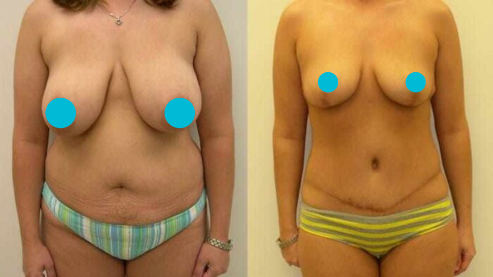 Mommy Makeover before and after - frontal view