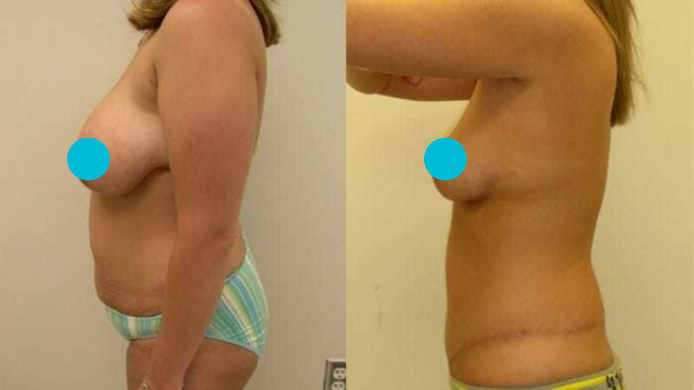Mommy Makeover before and after - profile view