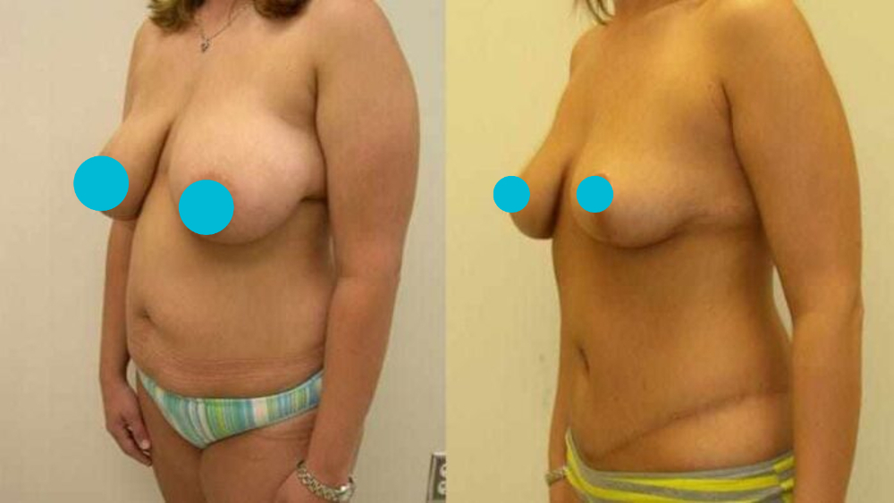 Mommy Makeover before and after - oblique view