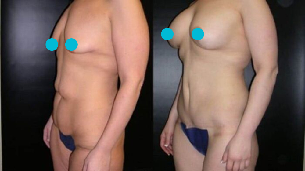 Mommy Makeover before and after - oblique view