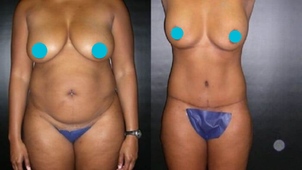 Mommy Makeover before and after - frontal view