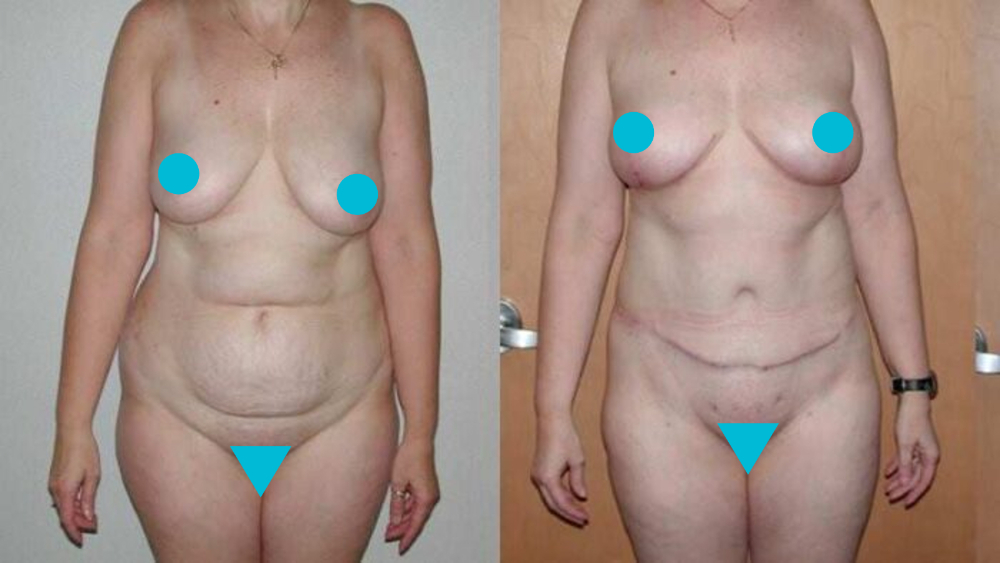 Mommy Makeover before and after - frontal view