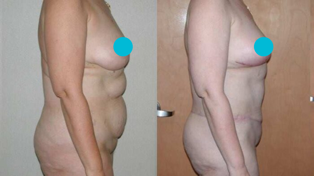 Mommy Makeover before and after - profile view