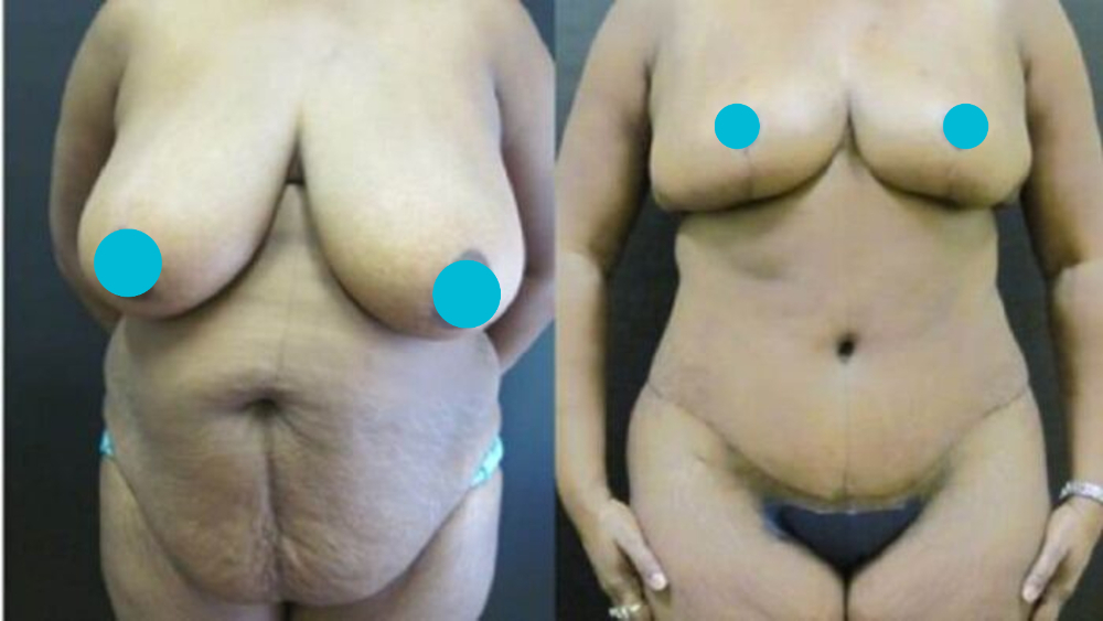 Mommy Makeover before and after - frontal view