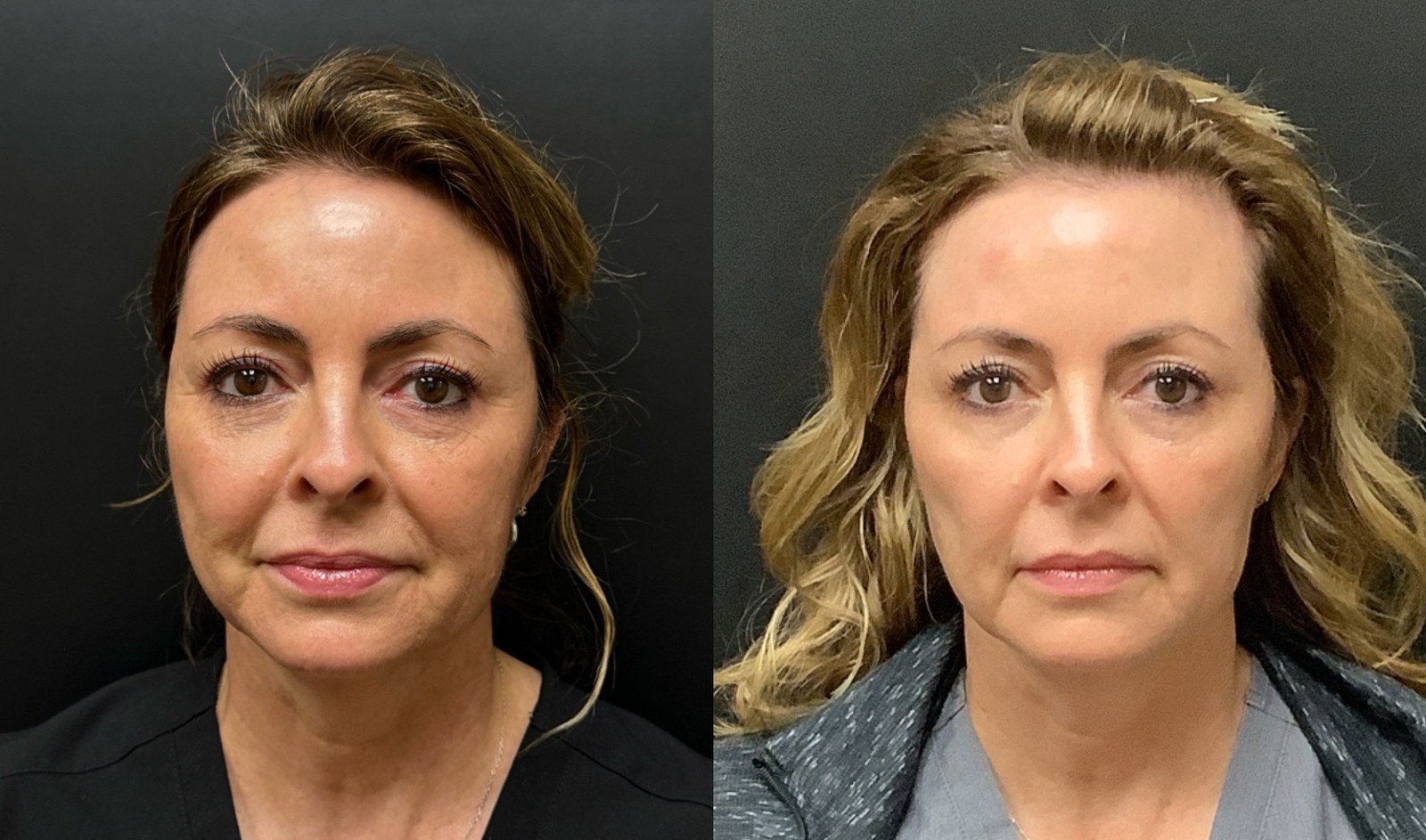 Radiesse before and after - frontal view