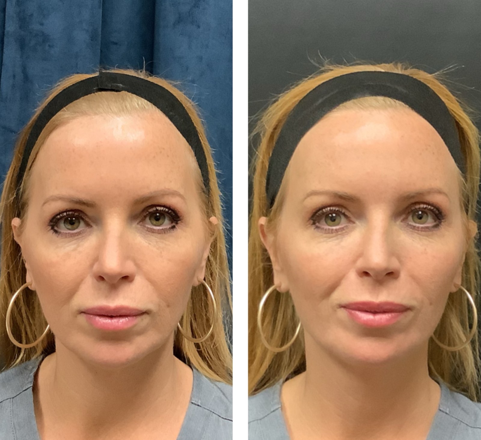 Radiesse before and after - frontal view