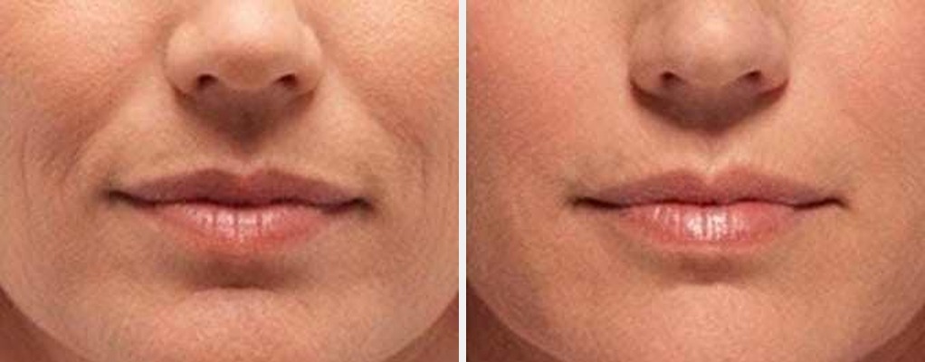 ThermiSmooth before and after - frontal view