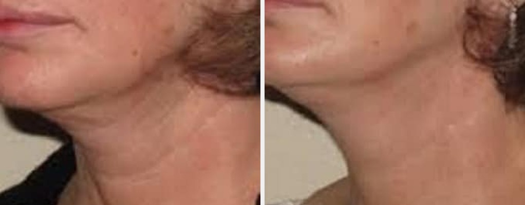 ThermiSmooth before and after - oblique view