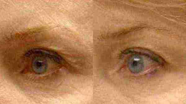 ThermiSmooth before and after - oblique view
