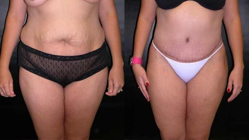 Tummy Tuck before and after - frontal view