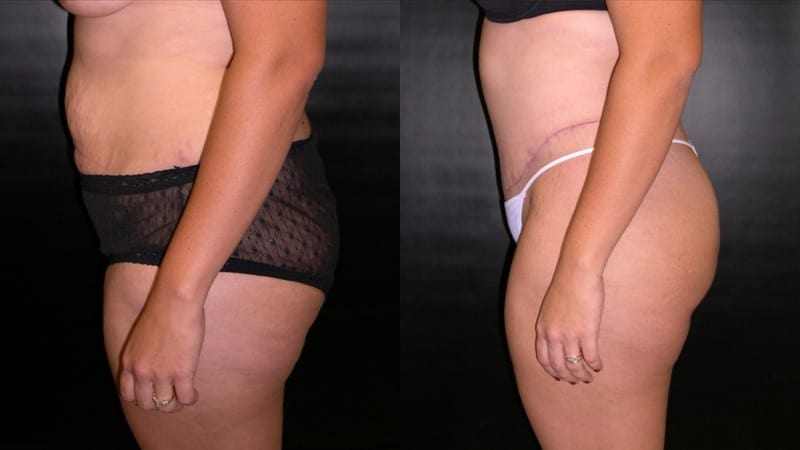 Tummy Tuck before and after - profile view