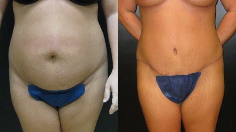 Tummy Tuck before and after - frontal view