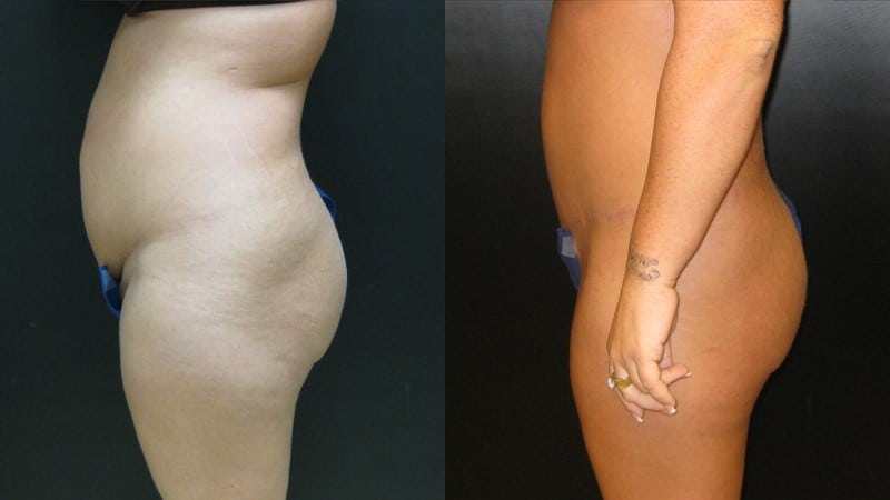 Tummy Tuck before and after - profile view