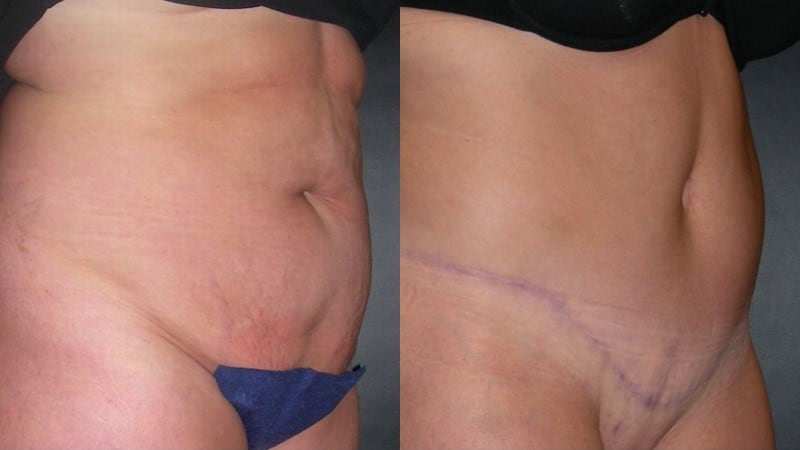 Tummy Tuck before and after - oblique view