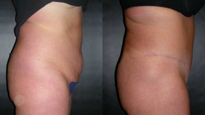 Tummy Tuck before and after - profile view