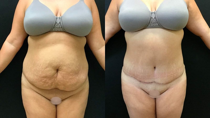 Tummy Tuck before and after - frontal view