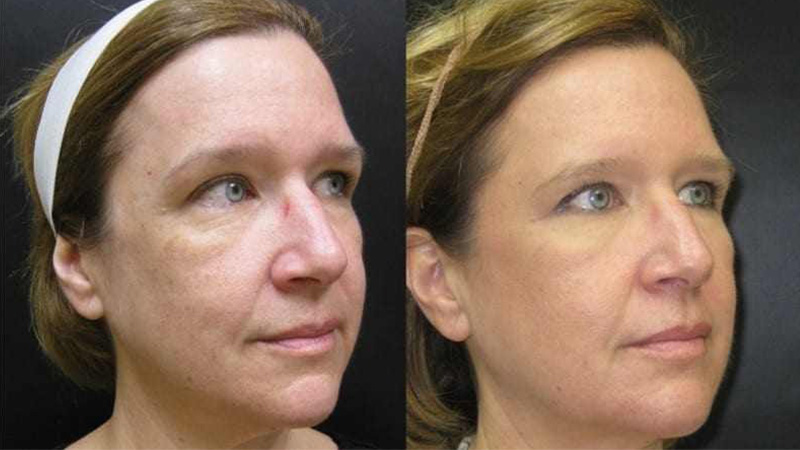 Ultherapy before and after - oblique view