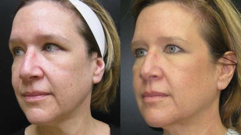 Ultherapy before and after - oblique view