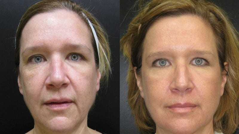Ultherapy before and after - frontal view