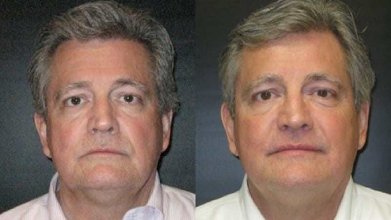 Ultherapy before and after - frontal view