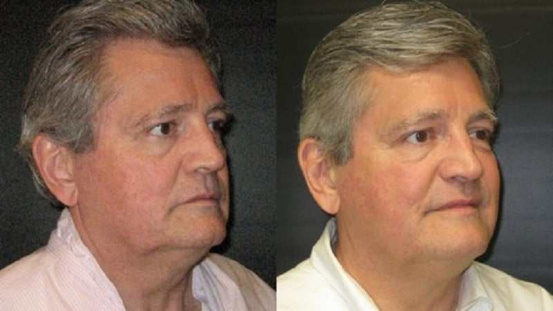 Ultherapy before and after - oblique view