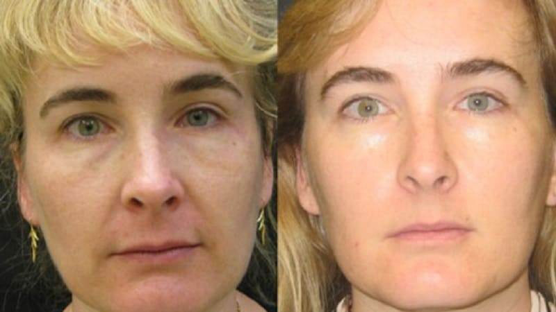 Ultherapy before and after - frontal view